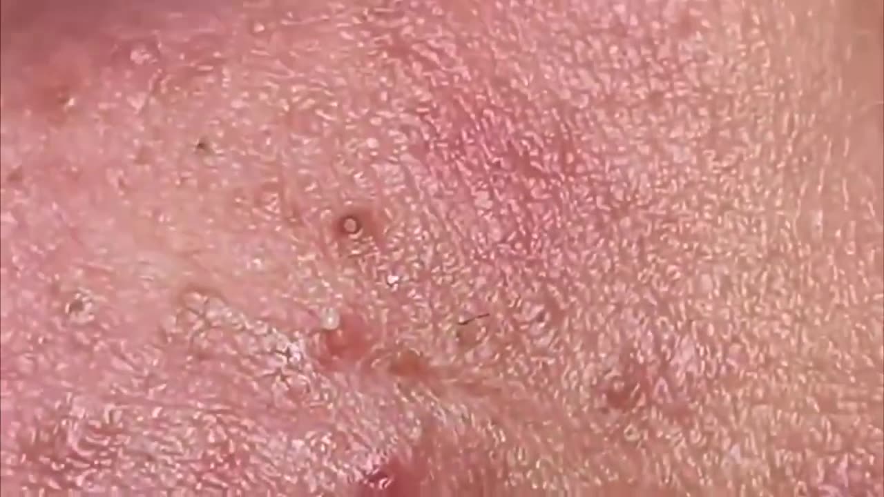 PIMPLE Popping! BLACKHEAD REMOVAL 2023! ACNE Treatment SPA VIDEO #new#newvideo