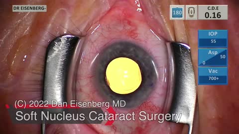 Soft Nucleus Cataract Surgery