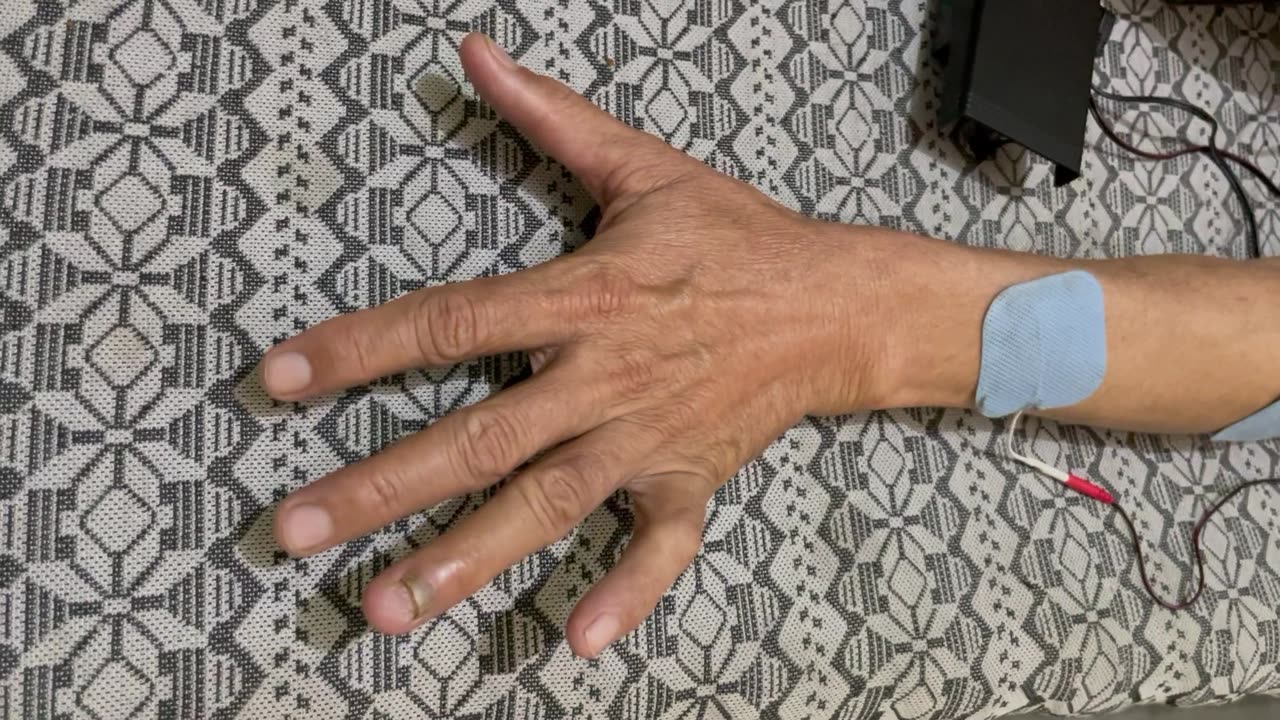 Stimulation for hand drop in paralysis