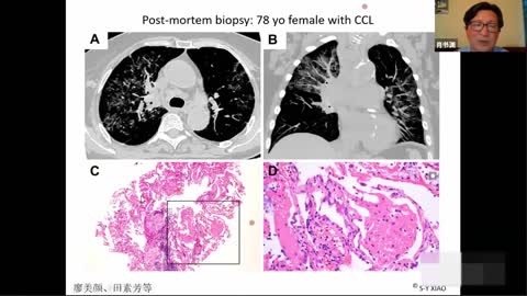 肖书渊【COVID-19 病理表现】