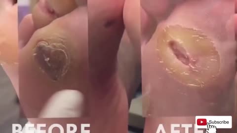 How Severe Callus Removed Satisfactorily