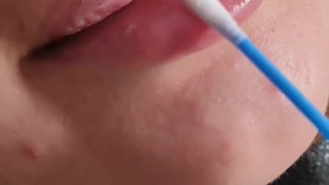 Lip filler