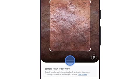Google Lens ¡Identifica afecciones en la piel!