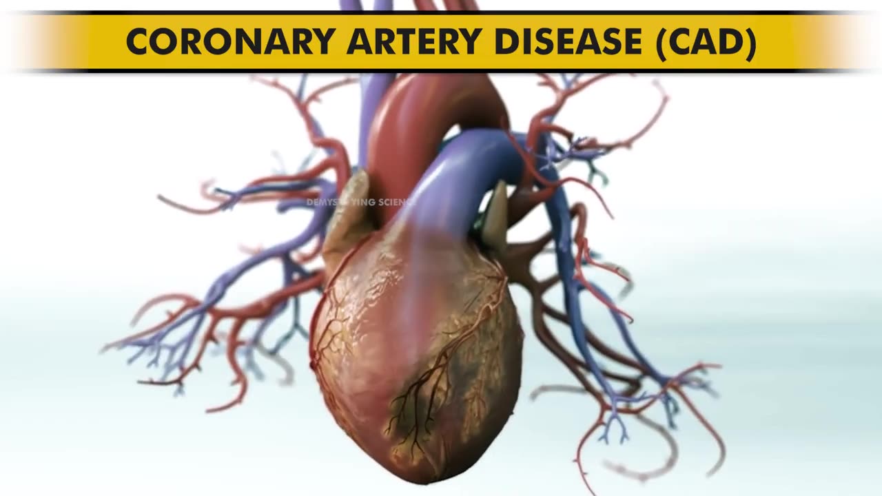 How Angioplasty Procedure is performed?