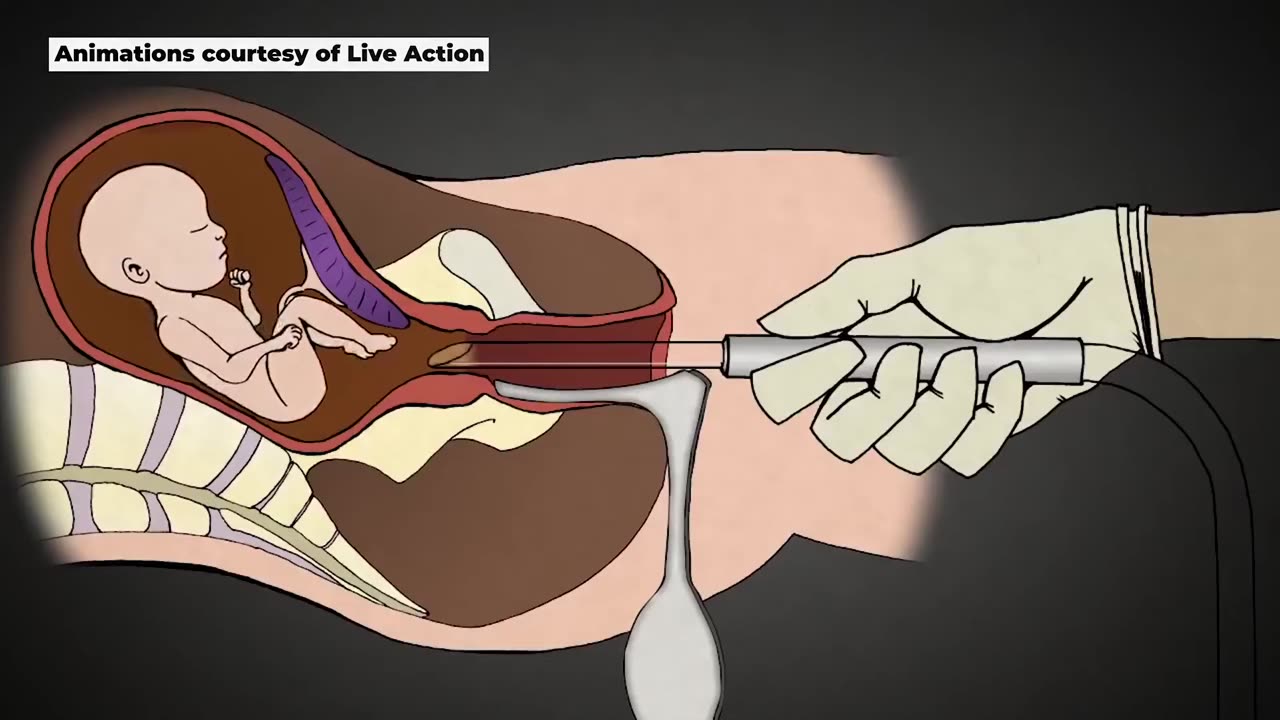 Reality of 2nd Trimester Surgical Abortions -Dr Norman NZ