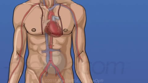 Coronary Artery Bypass Graft