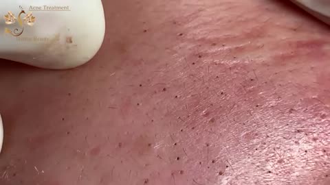# 223 | ACne Treatmetn Huong beauty | Part2