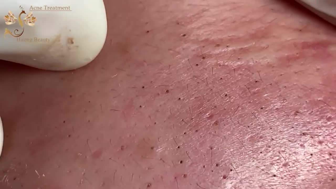 # 223 | ACne Treatmetn Huong beauty | Part2