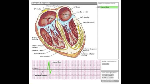 Dr Stanley's ECGcourse.com | Agonal-Asystole Rhythm Tutorial