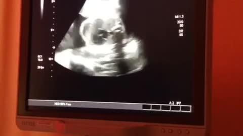 ultrasound of the baby in the womb