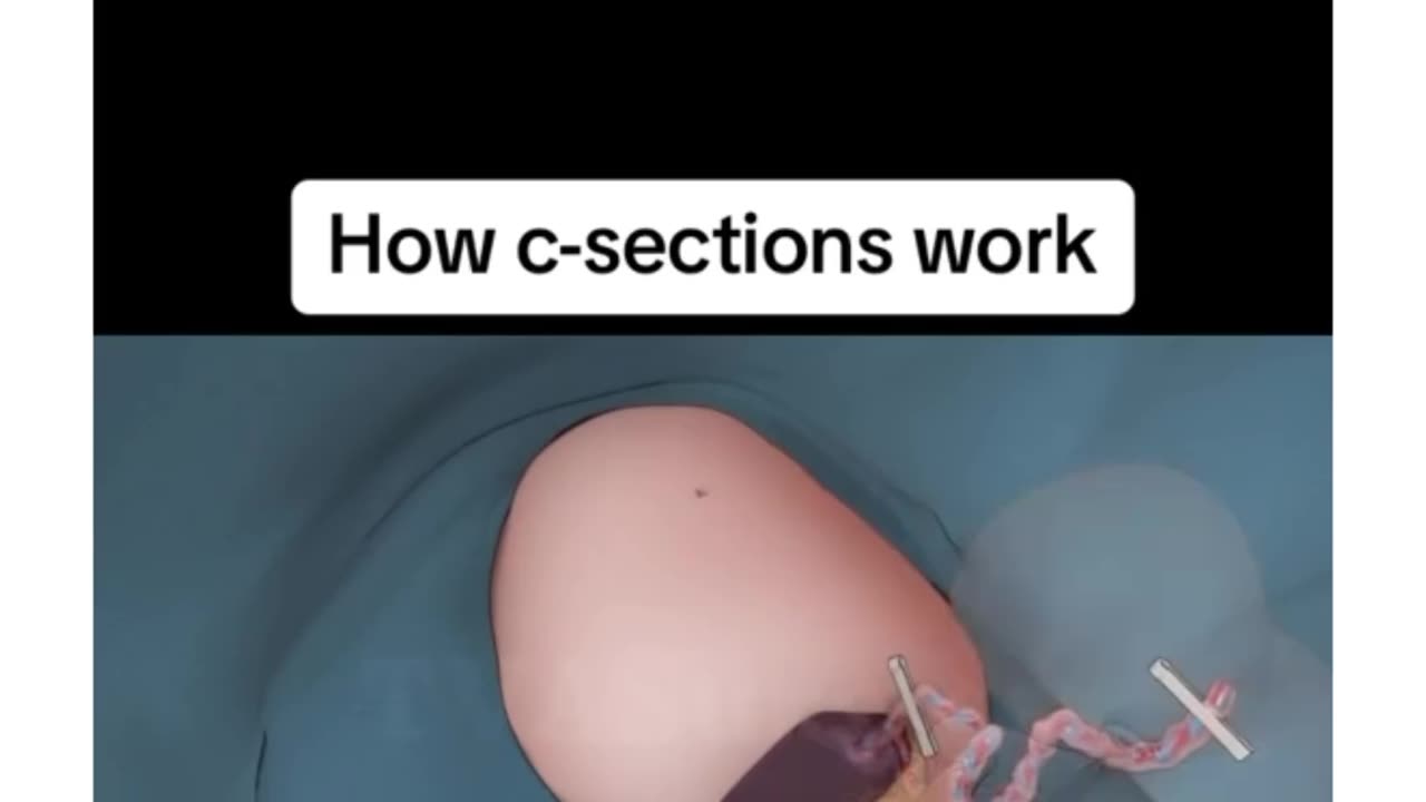 How c-sections work