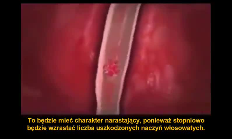 Dr Charles Hoffe - Katastrofalne skutki stosowania szczep. mRNA