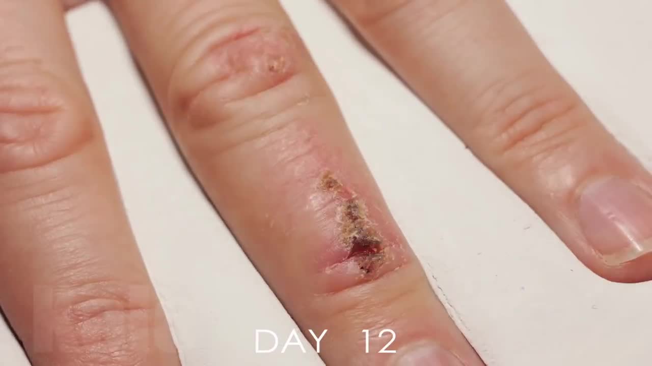 Timelapse Of a Wound Healing