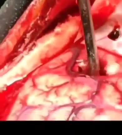 THIS IS WHAT THE VACCINE DOES TO YOUR BRAIN #ClotShot