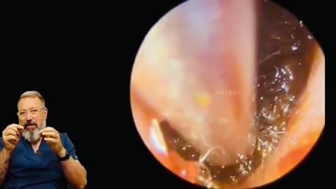 The Most Shocking Ear Wax Removal You've Never Seen - EP1041