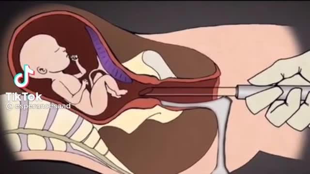 ABORTION 2nd Trimester