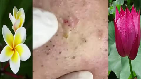 Removing Blackheads and Pimples from the Face Satisfactory Videos