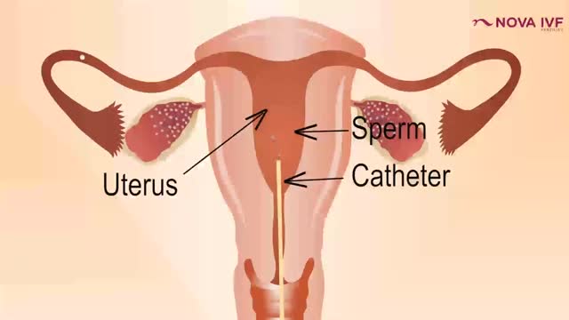 Check Dr Rohit Explains About IUI Treatment | NOVA IVF