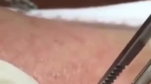 Biggest Blackhead Ever Recorded