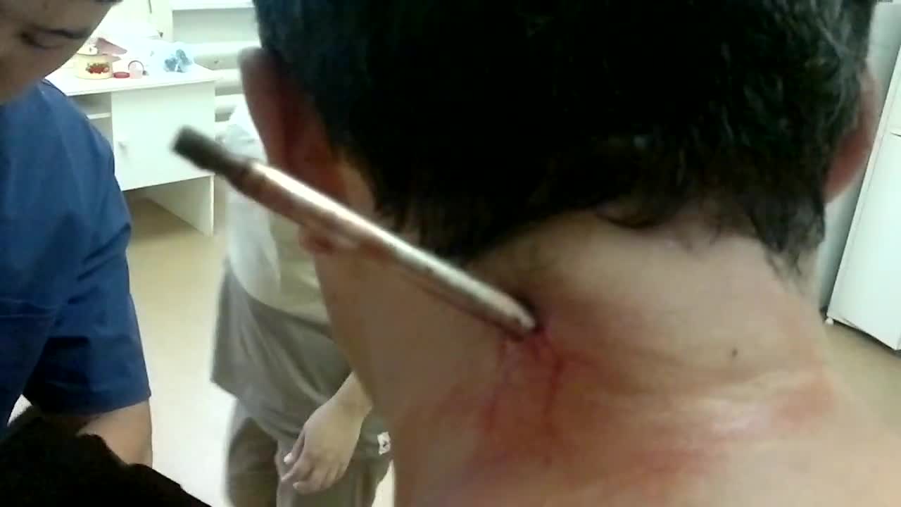 Fishing Spear Caught on Human