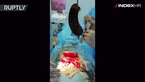 Kazakhstan: 3.5kg hairball removed from 12y/o girl’s stomach *GRAPHIC*