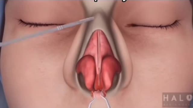How to perform rhinoplasty