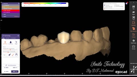 #design #naildesign #dental #dentaldesign #exocadexpert