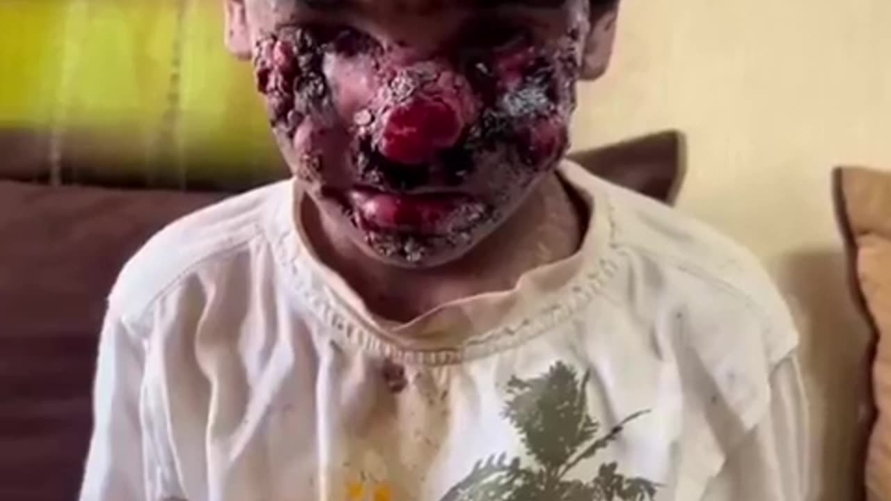 Terrorist Zionist occupation soldiers disfigure the face of a Palestinian child in Gaza