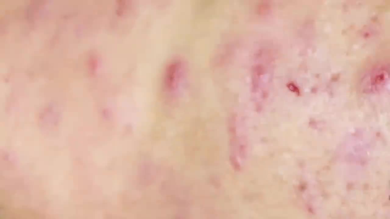 Blackhead removal on face video | Relax Every Day