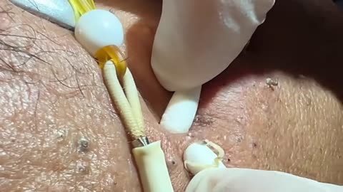 blackhead