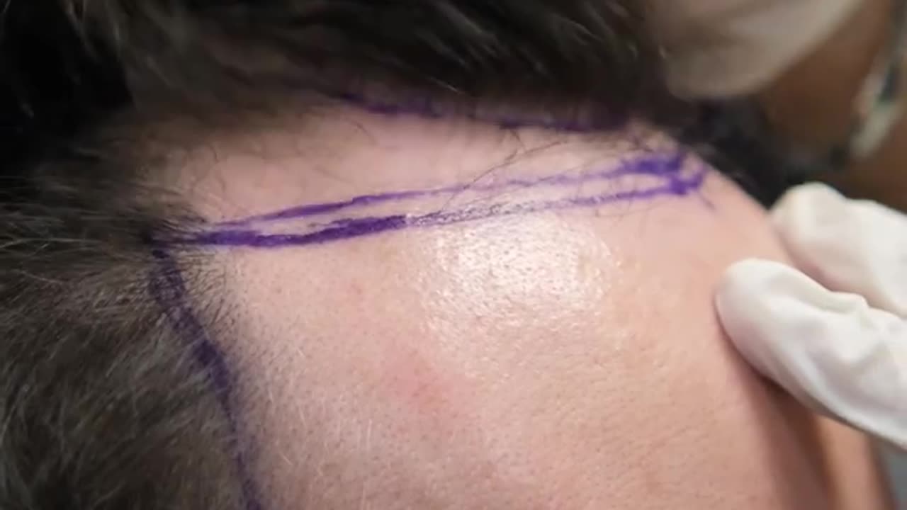 HAIR TRANSPLANT DAY OF A PATIENT