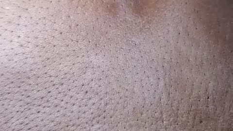 Another huge back black head squeeze