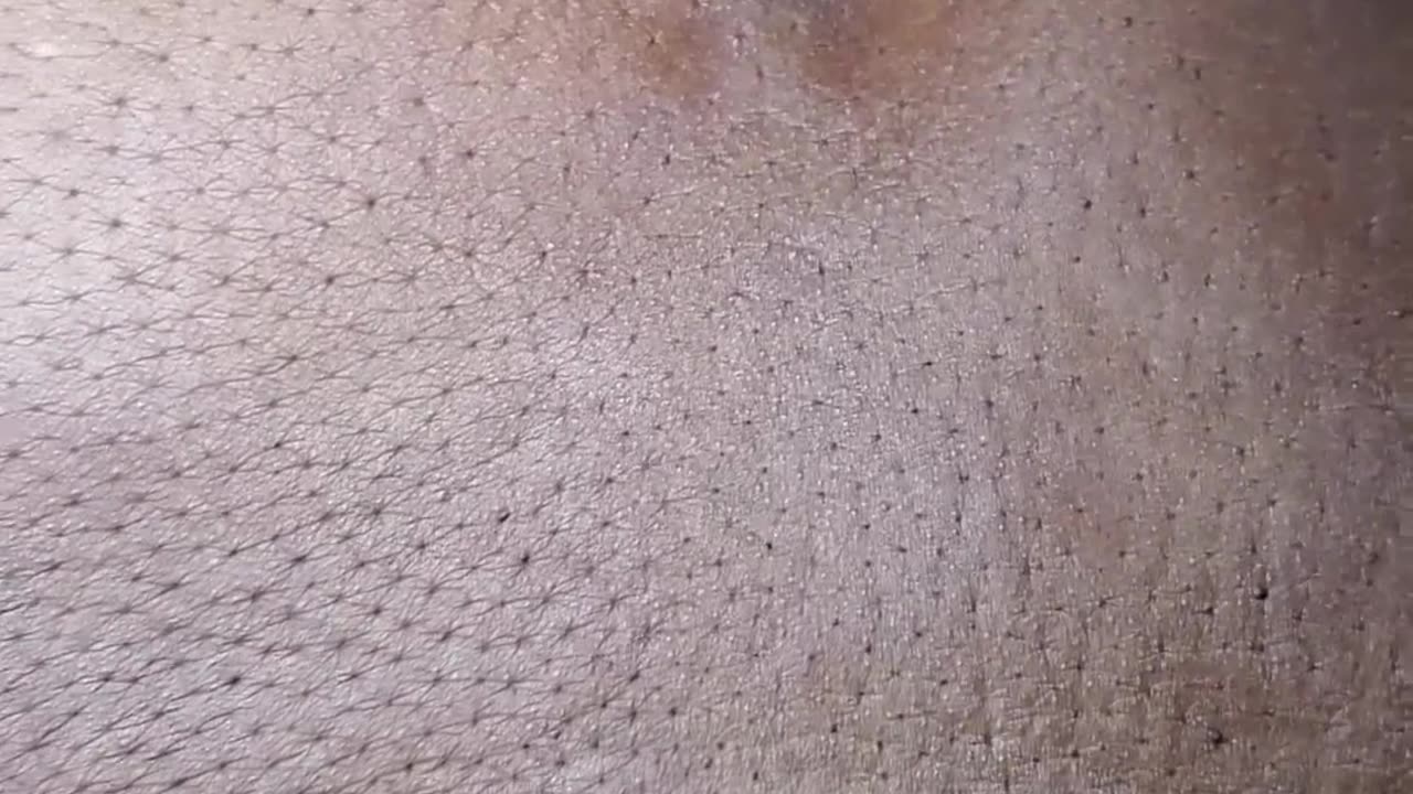 Another huge back black head squeeze