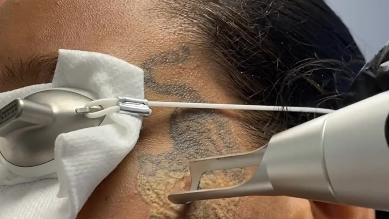 Laser Tattoo Removal