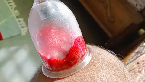 Cupping for Knee pain Relief from Upstraight View