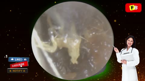 Ear Wax Removal PART 14