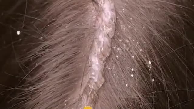 Teach you how to get rid of dandruff and lose belly