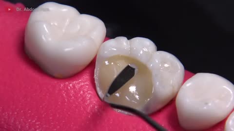 AMAZING reconstruction of tooth damaged by caries: