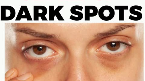 Why You Have Dark Spots/Circles Beneath Your Eyes ( The Solutions)