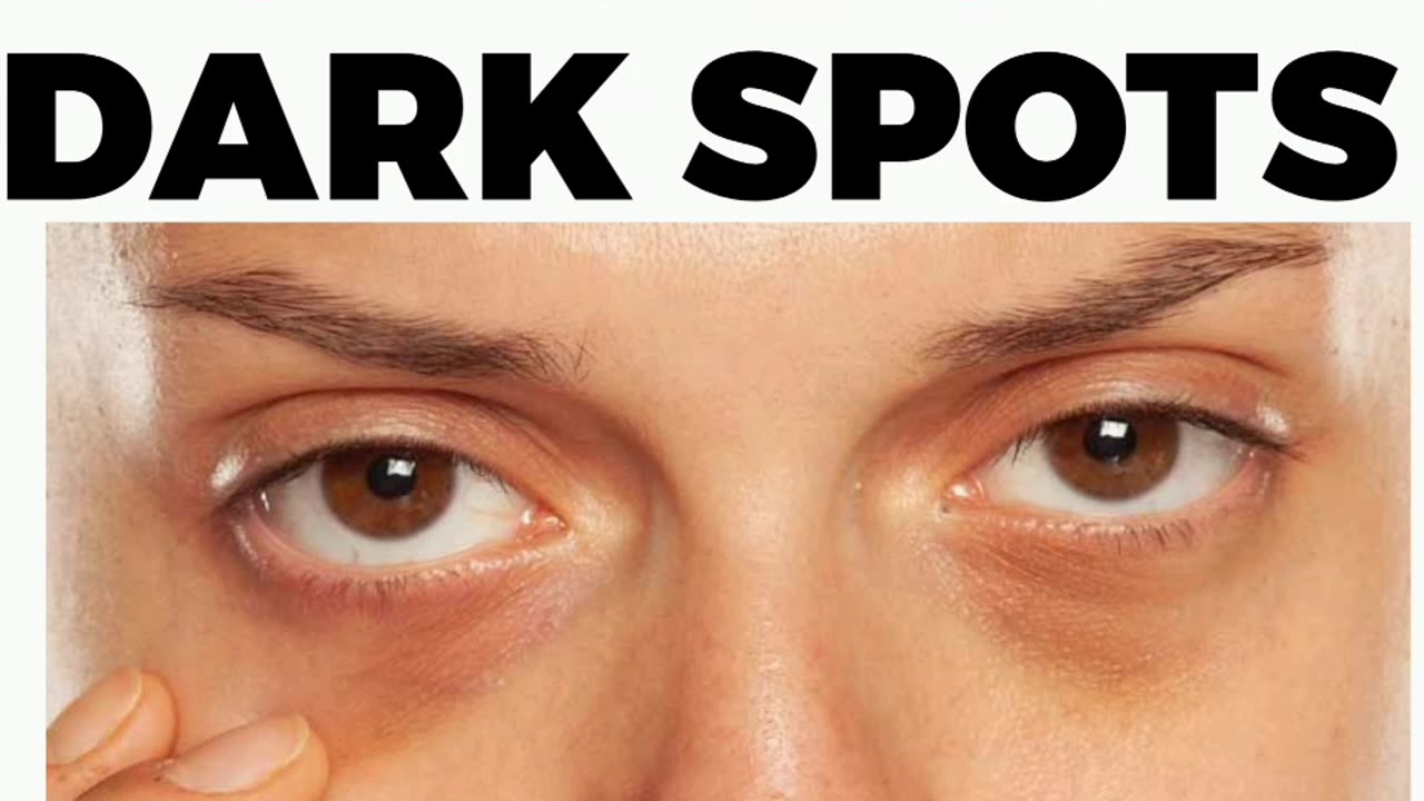 Why You Have Dark Spots/Circles Beneath Your Eyes ( The Solutions)