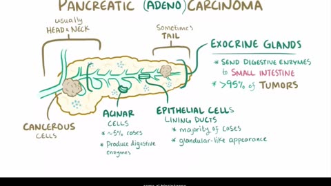 acute pancreatitis