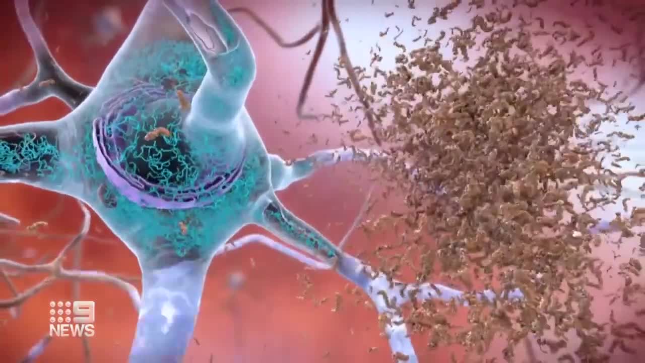 New treatment could slow cognitive decline of Alzheimer’s Disease