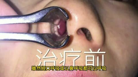 嘴巴呼吸 污染直接吸進體內