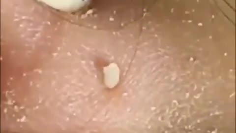 LONG CYST EXTRACTION