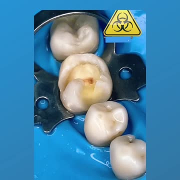 Removing large cavities from the middle of a tooth... Laborious