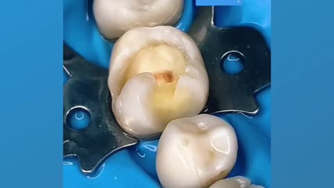 Removing large cavities from the middle of a tooth... Laborious