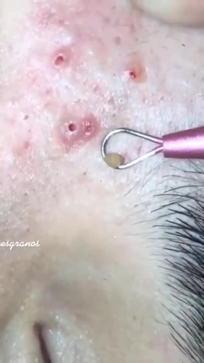 Pimple Popping Blackheads