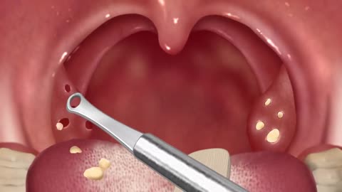 Tonsil stone remove animation