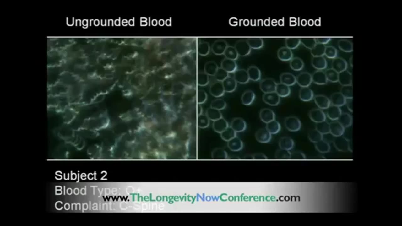 The Benefits of Grounding： Blood Un-clumping After 45min of Being Grounded