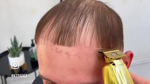 Saving A Receding Hairline